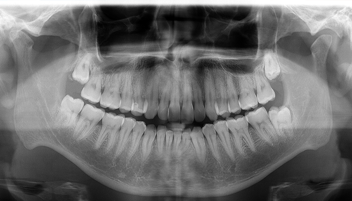 歯周病治療治療の流れ